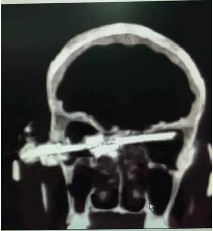CT图-1：砂轮插入脑袋的影像