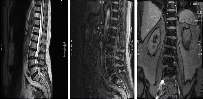 图1 腰椎MRI