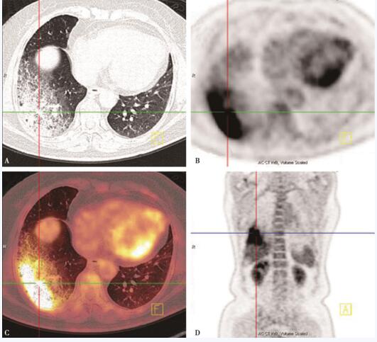 图2 右肺下叶大片实变影及磨玻璃影，代谢活性弥漫明显增高（十字交叉）
