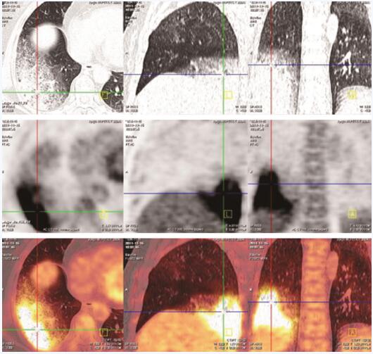 图3 右肺下叶大片实变影及磨玻璃影，代谢活性弥漫明显增高（十字交叉）