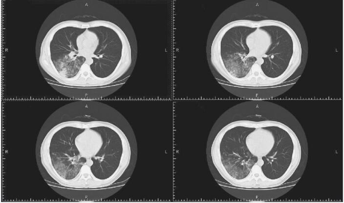 图2 胸部CT检查提示右下肺大片高密度渗出影