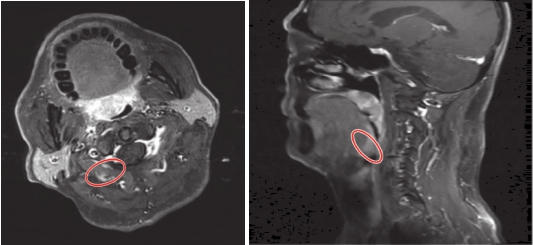 图1 口咽病灶增强鼻腔MRI（第一次治疗前2015-06）：提示左侧软腭区增厚与右侧口咽、悬雍垂分辨不清-0aeadf6787fd42c19570c8f2653e036f