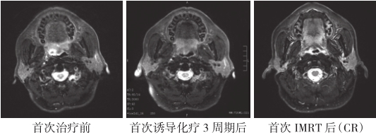 图3 首次治疗前、中、后疗效影像评估-9b908815ea474acd9fe11a4fb19d6e9e