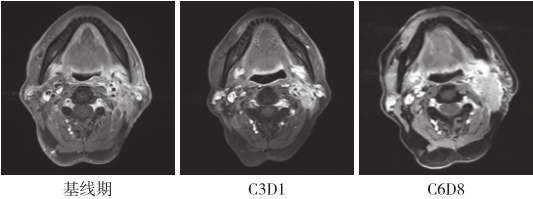 图8 颈部增强MRI（化疗中及化疗结束后）：提示稳定（SD）-0ac082a38add4cad8532e3f5bdf01c9a