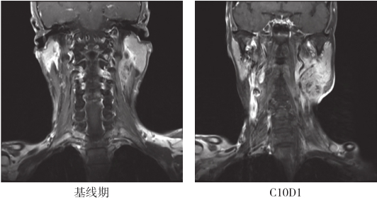 图9 靶向维持阶段颈部增强MRI（化疗中及化疗结束后）：提示进展（PD）-b6cac60583e04d16abb87f70dd760591