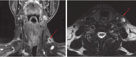 图2 颈部增强MRI（基线）.jpg