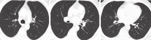 图3 胸腹盆增强CT可见双肺小结节.jpg