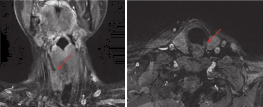 图4 颈部增强MRI：2疗程后达PR.jpg
