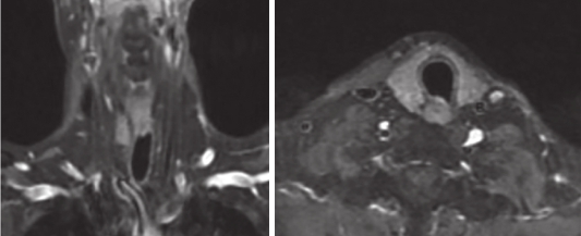 图5 颈部增强MRI：6疗程后靶病灶缩小为不可测量病灶，维持PR.jpg