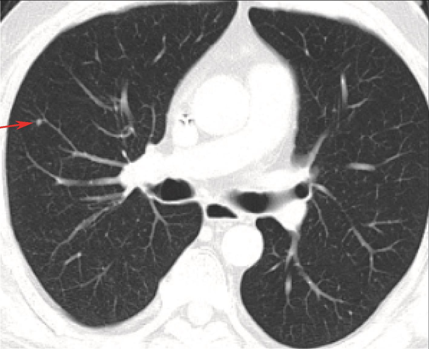 图6 2016-06胸腹盆增强CT，右肺新发小结节-.jpg