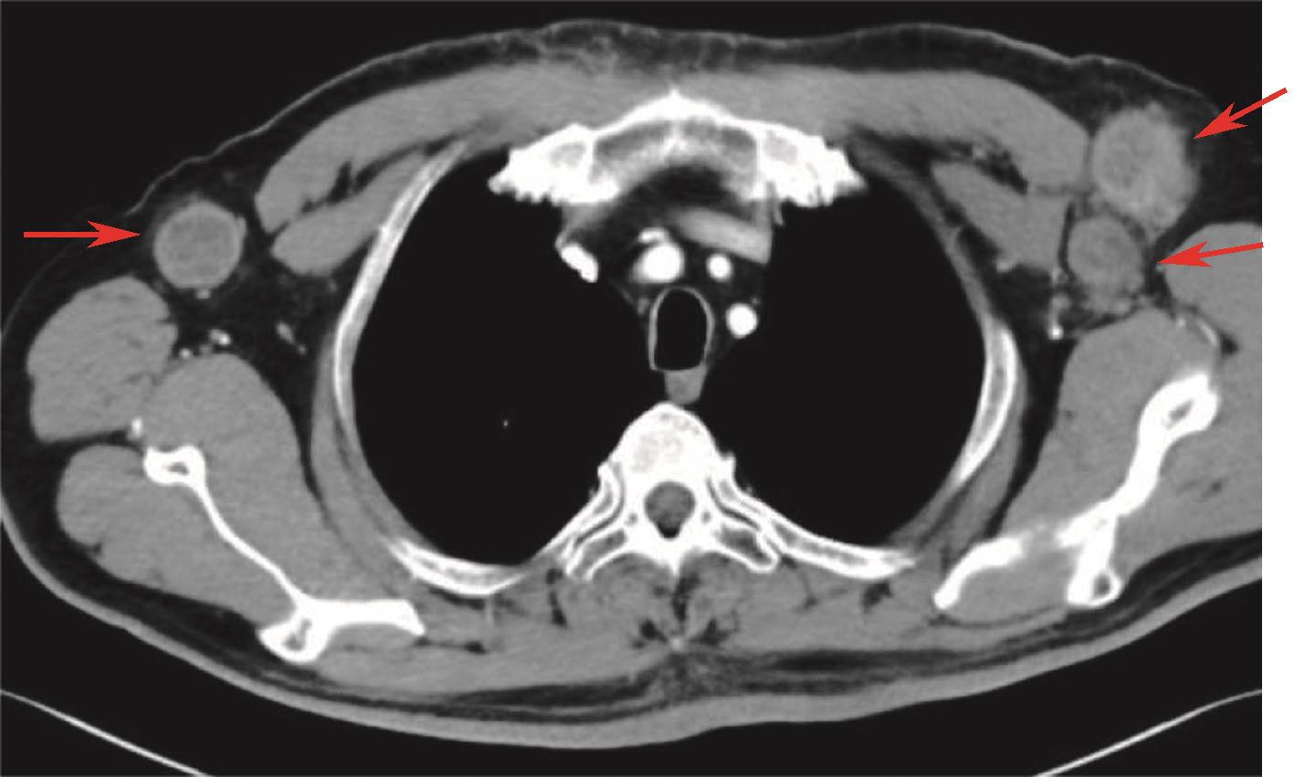 图7 胸腹盆增强CT：提示双侧腋窝多发淋巴结.jpg