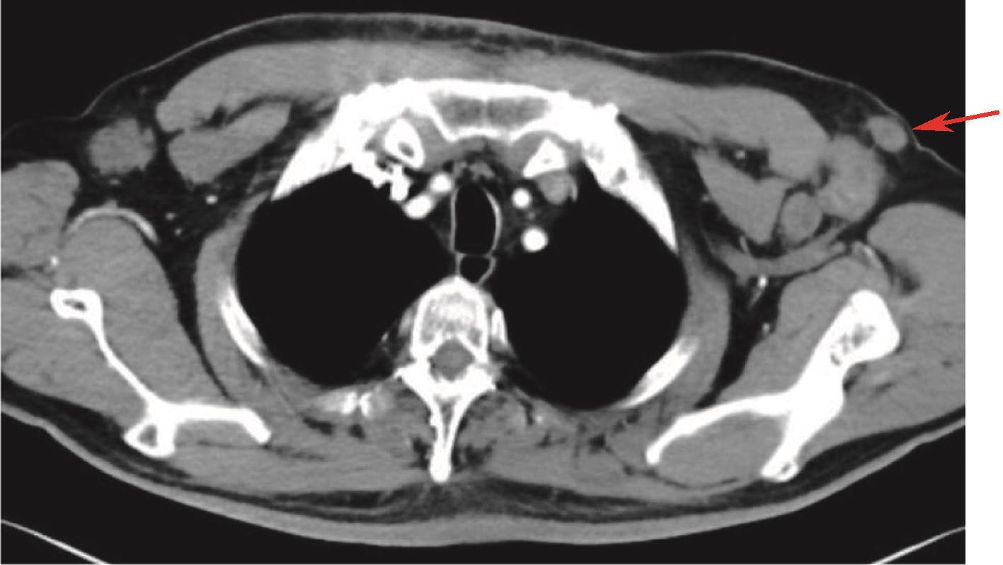 图8 胸腹盆增强CT：左侧腋窝皮下新发小结节.jpg