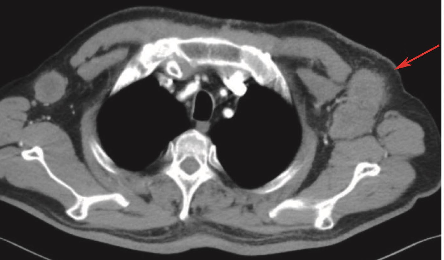 图9 胸腹盆增强CT：提示左腋窝淋巴结增大.jpg