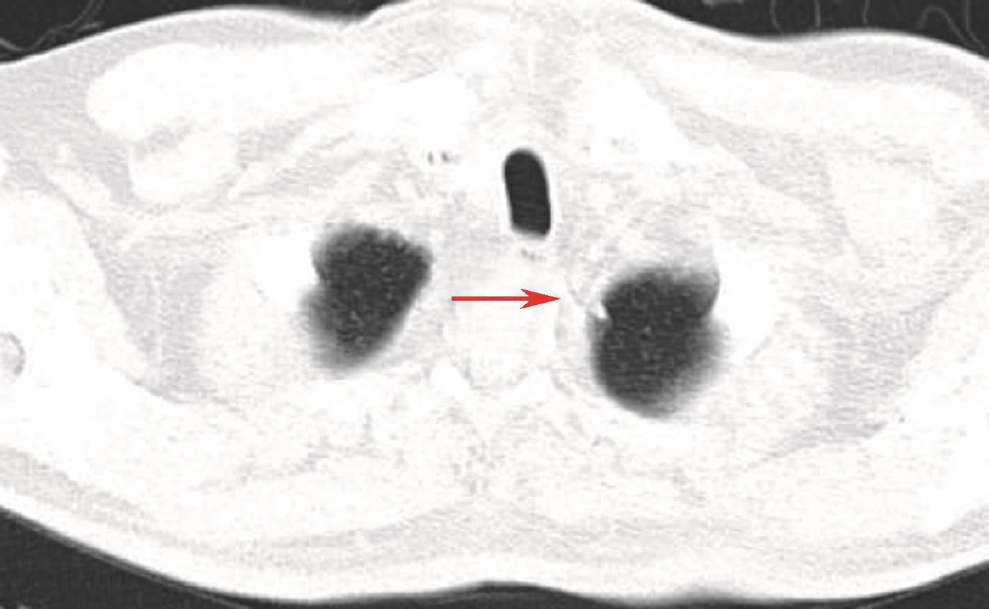 图10 颈胸增强CT可见左肺尖新发结节.jpg
