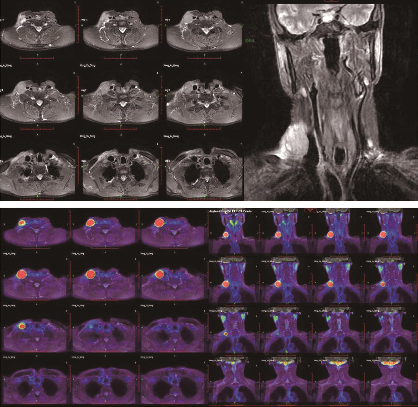 图1 全身PET-MRI