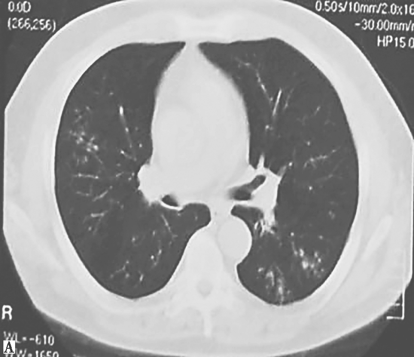图1（1）胸部CT表现（2011-12-28）.jpg