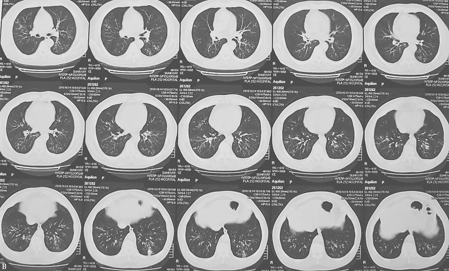 图1（2）胸部CT表现（2011-12-28）.jpg