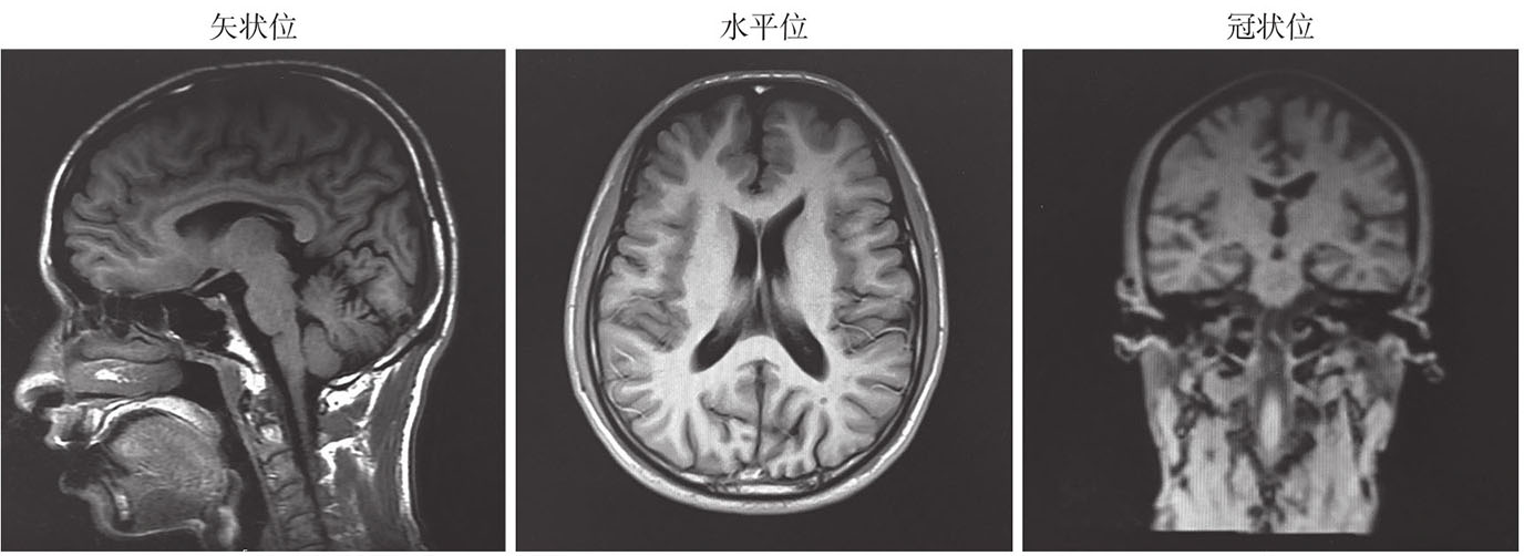 图2 患者头颅磁共振表现.jpg