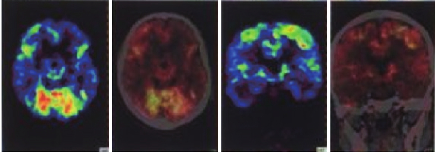 图4 患者11C-PiB-PETCT表现.jpg