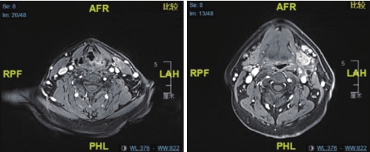 图2（1）喉MRI及腹部MRI（2疗程后）.jpg
