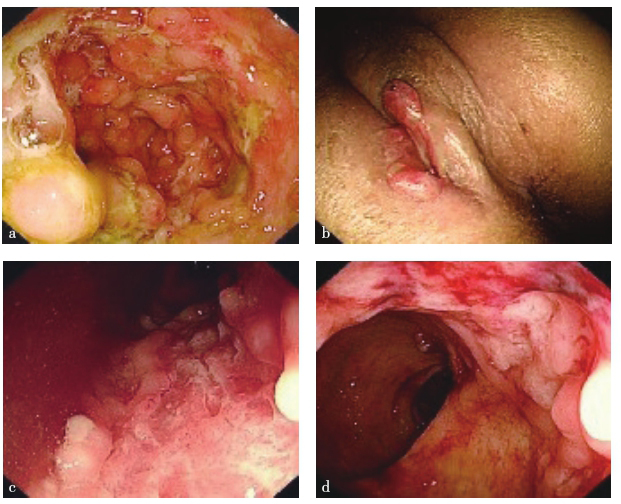图2 肠镜检查所见.jpg