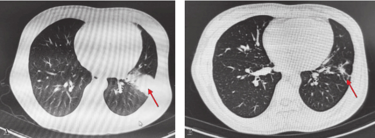 图3 肺部CT对比.jpg