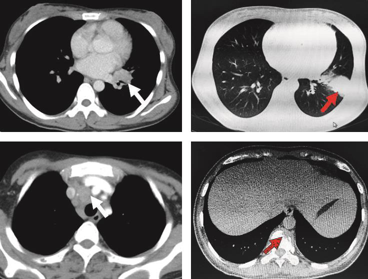 图1 肺部CT.jpg