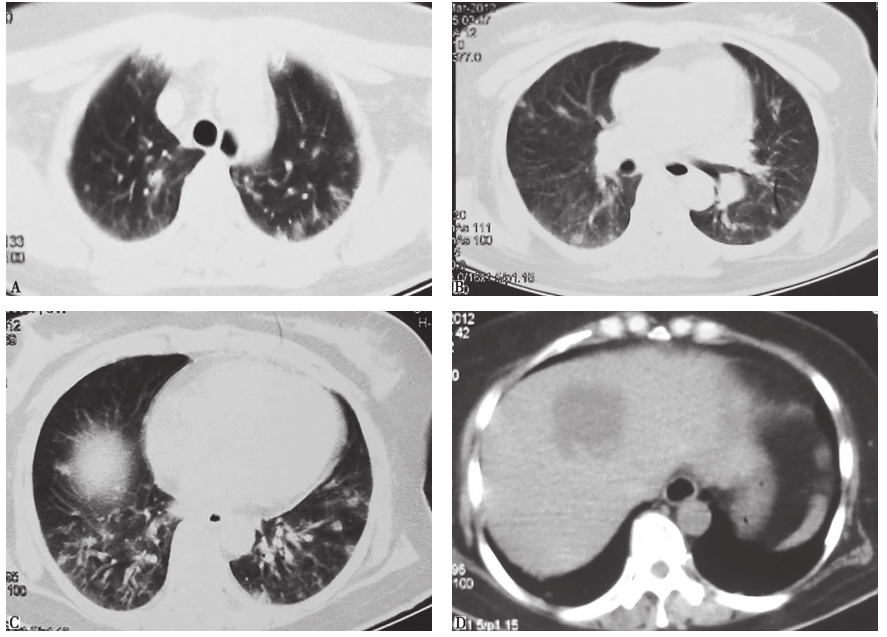 图1 发病第2天胸部CT表现.jpg