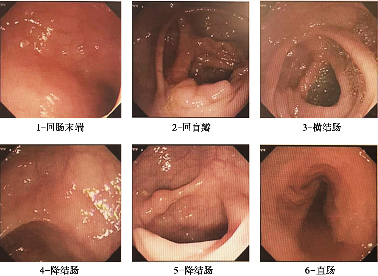 图3 肠镜.jpg