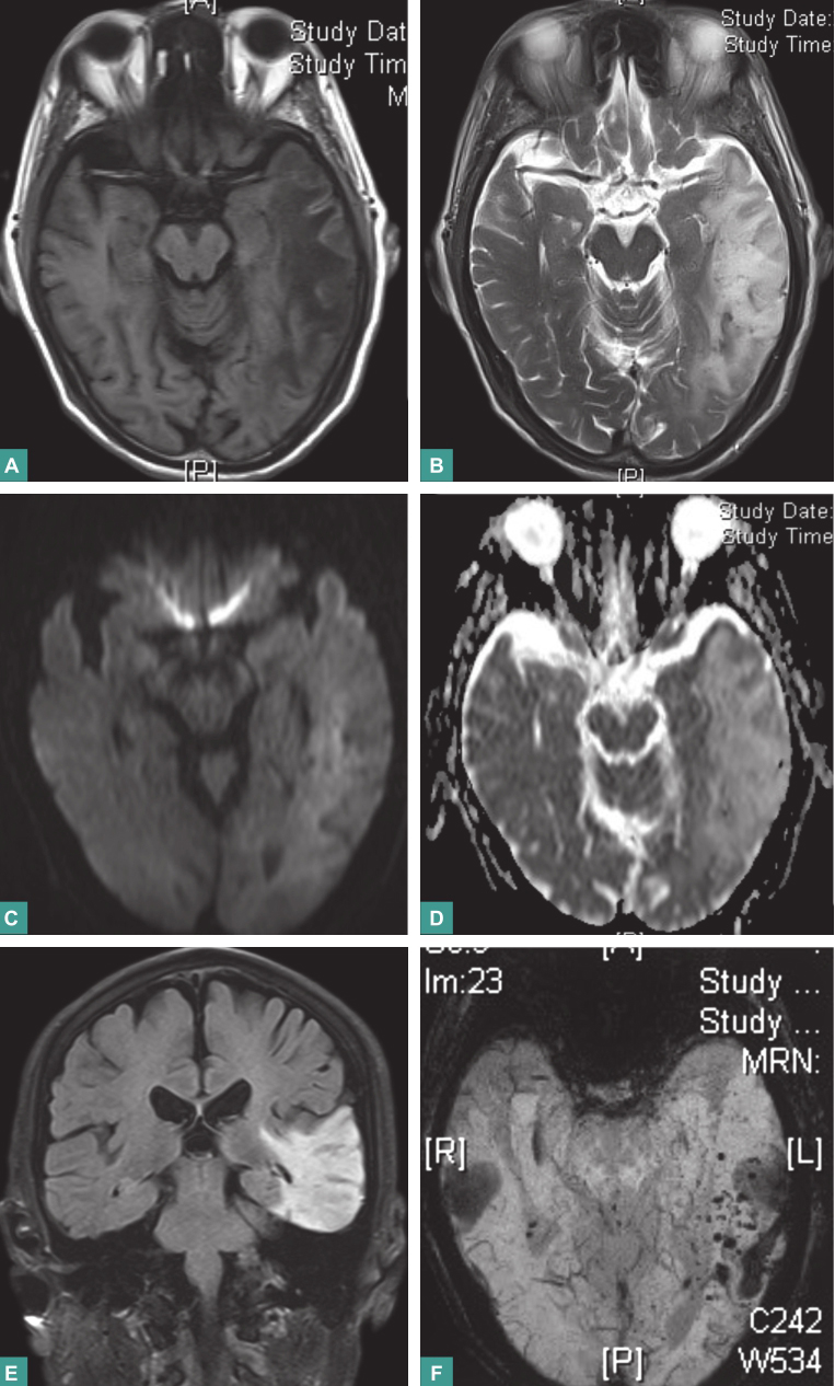 图5 栓塞术后复查颅脑MRI.jpg