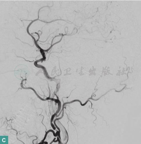 图4 图左侧枕区硬脑膜动静脉瘘血管内栓塞术前、中、后DAS影像-C.jpg