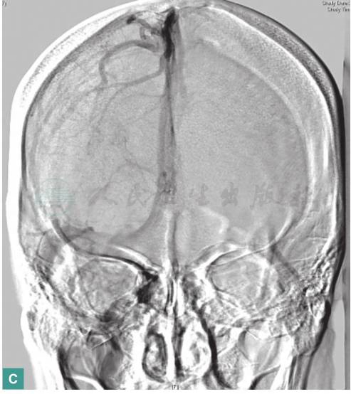 图3 DSA示左侧横窦、乙状窦血栓形成-C.jpg