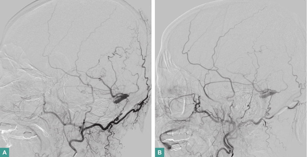 图2  DSA示左颞枕部硬脑膜动静脉瘘-AB.jpg