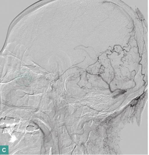图2  DSA示左颞枕部硬脑膜动静脉瘘-C.jpg