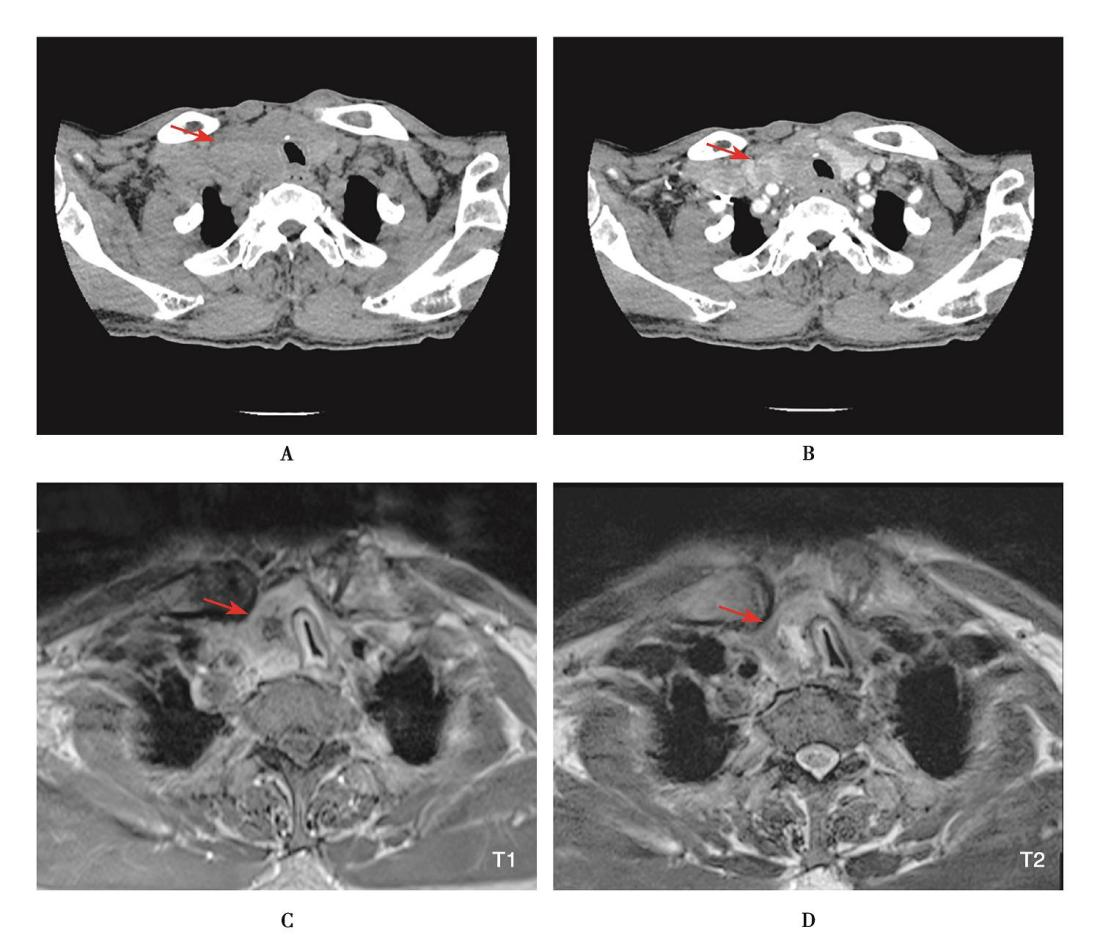图6 甲状腺乳头状癌颈部CT、MRI表现