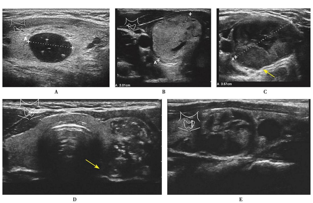 图3 不同性质甲状腺结节B超表现