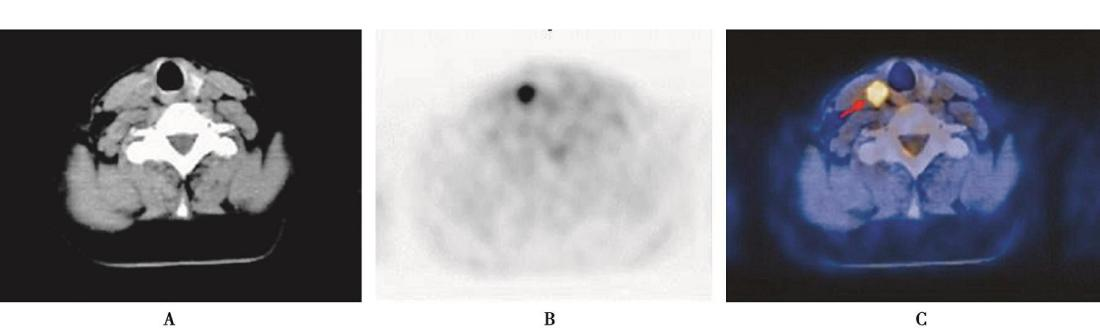 图2 甲状腺高葡萄糖代谢结节18F-FDG PETCT图像