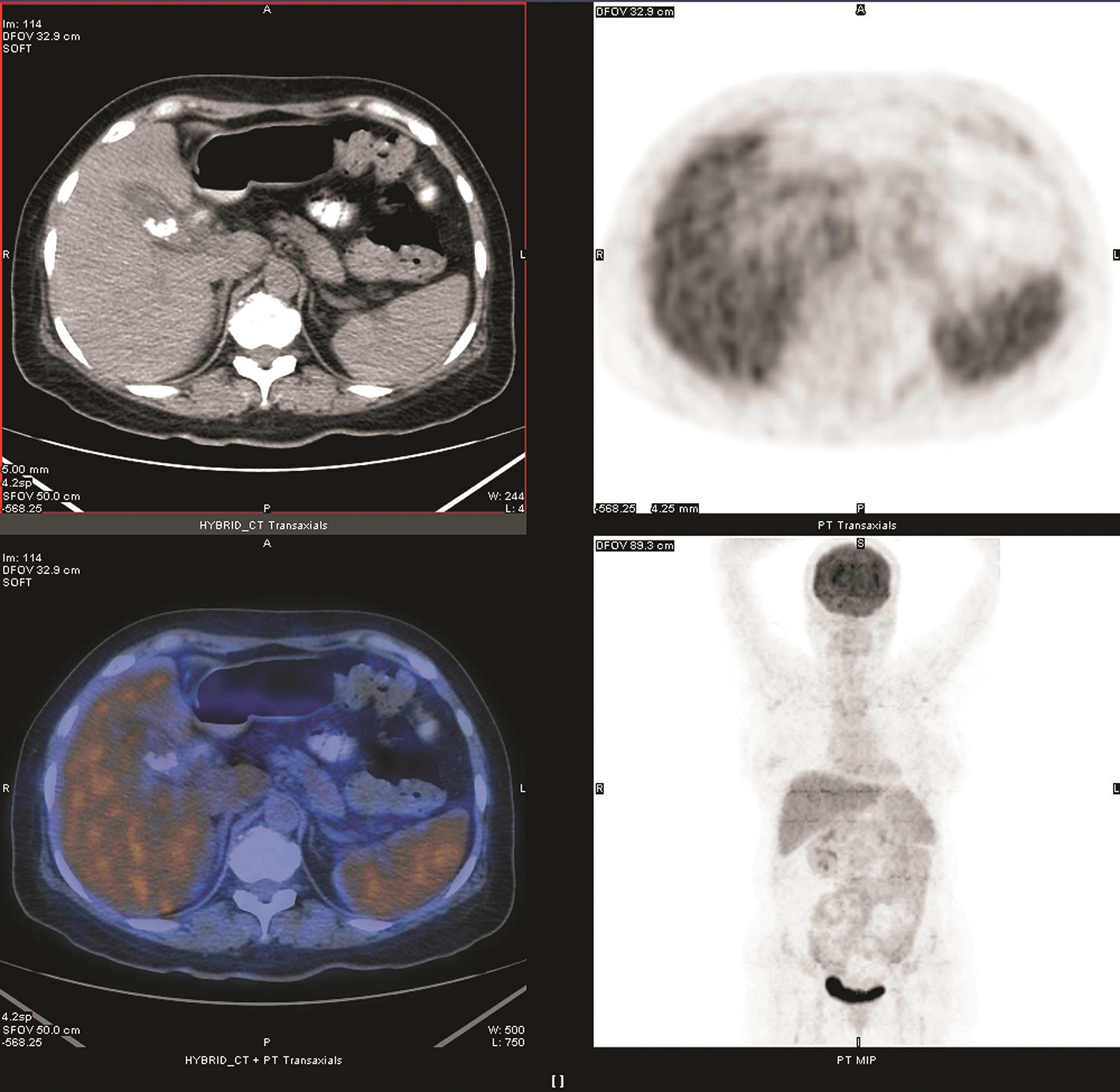 图2 全身PET-CT