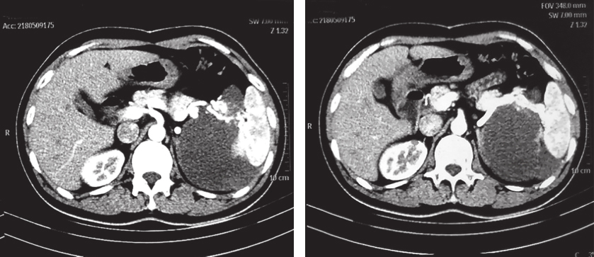 图2 2018年5月9日增强CT.jpg