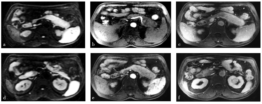 图1 磁共振成像［弥散加权成像技术（diffusion weighted imaging，DWI）、增强早期+晚期、门脉期］.jpg