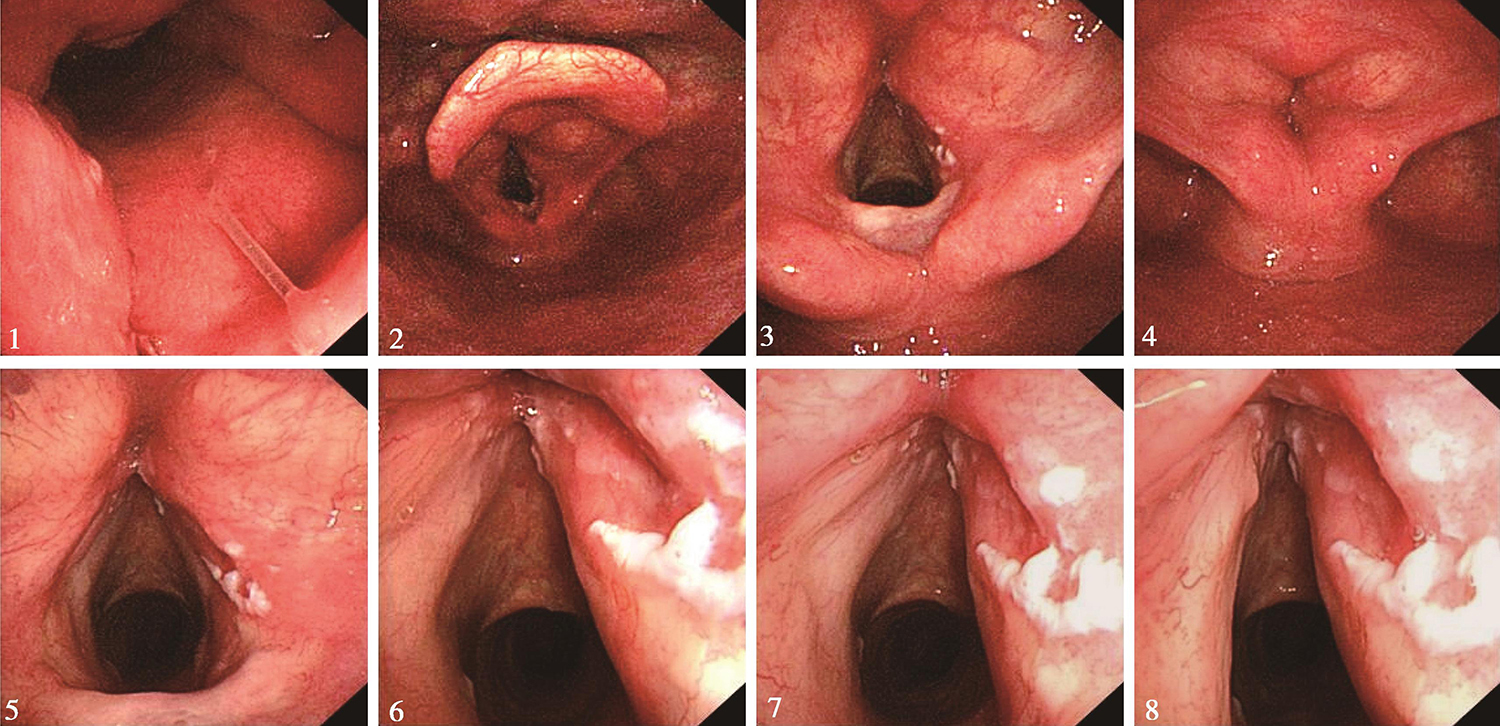 图1 喉镜示声门区右侧声带表面覆盖白斑