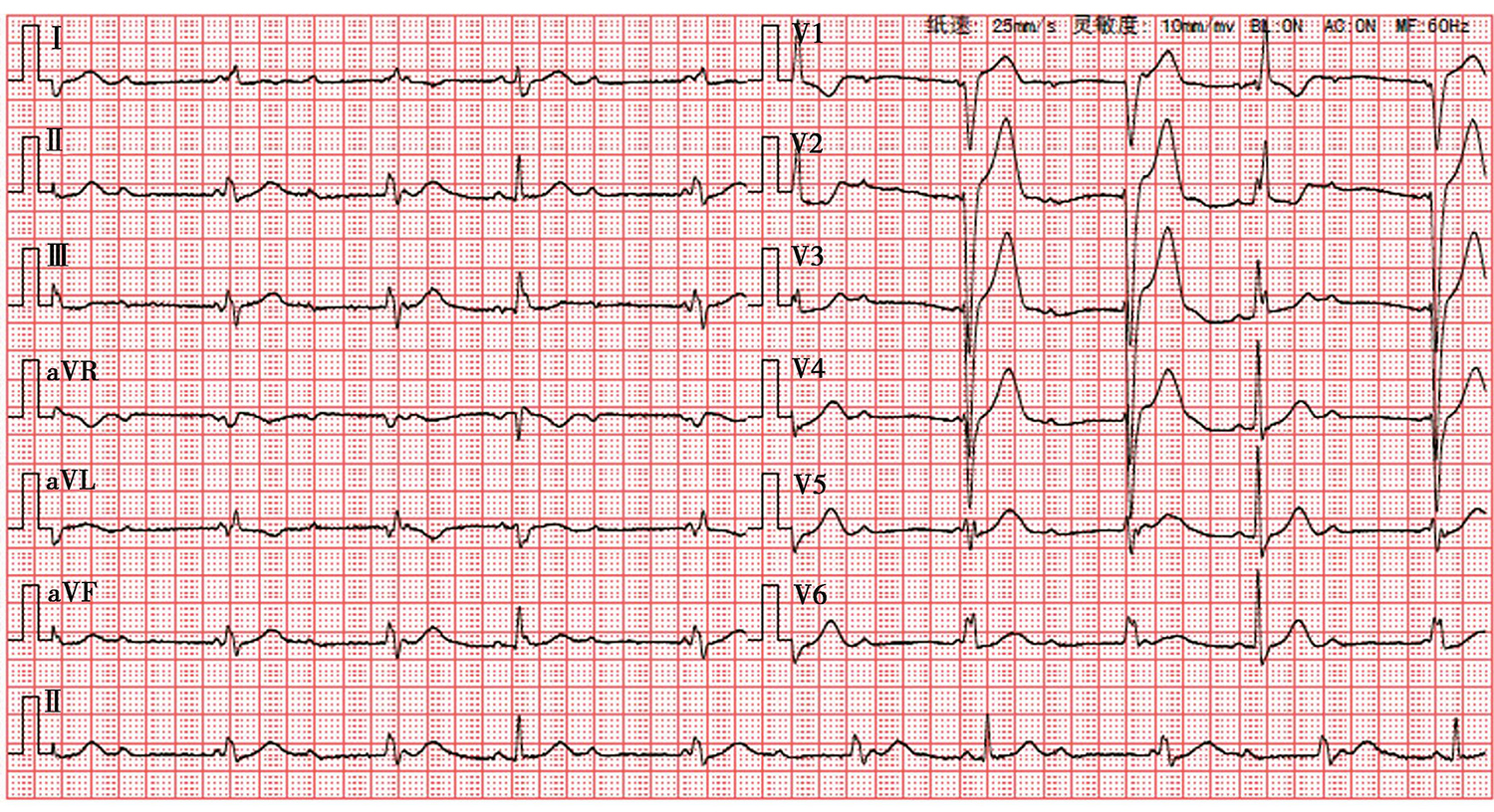 图3 心电图示：窦性心律；完全性右束支阻滞；高度房室传导阻滞；频发房室连接处逸搏伴完全性左束支阻滞；心率：58次min.jpg
