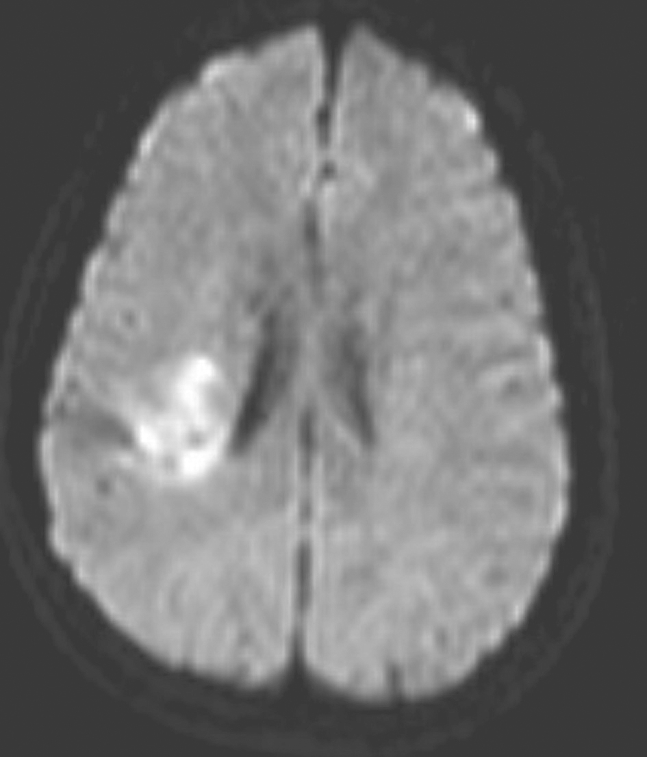 图3 发病后2个月余颅脑MRI DWI像.jpg