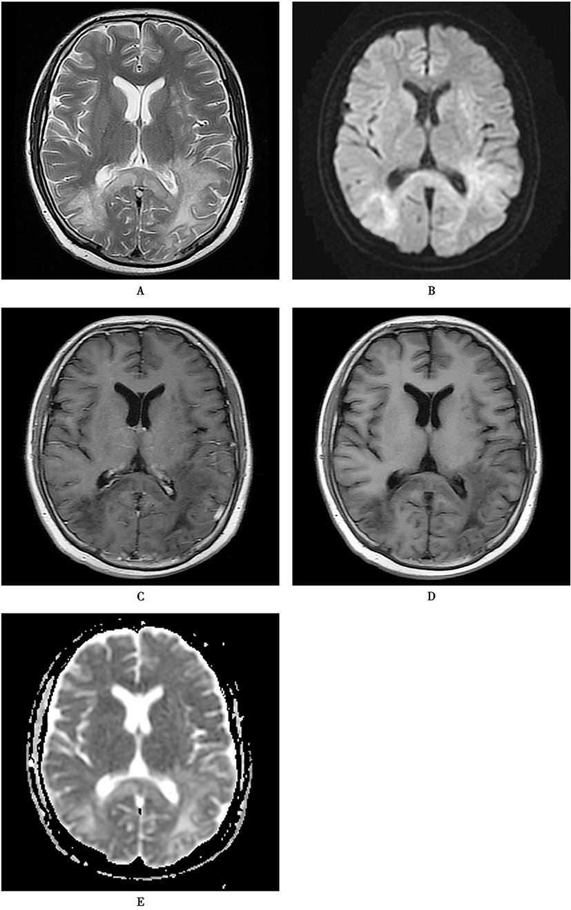 图11 进行性多灶性白质脑病.jpg